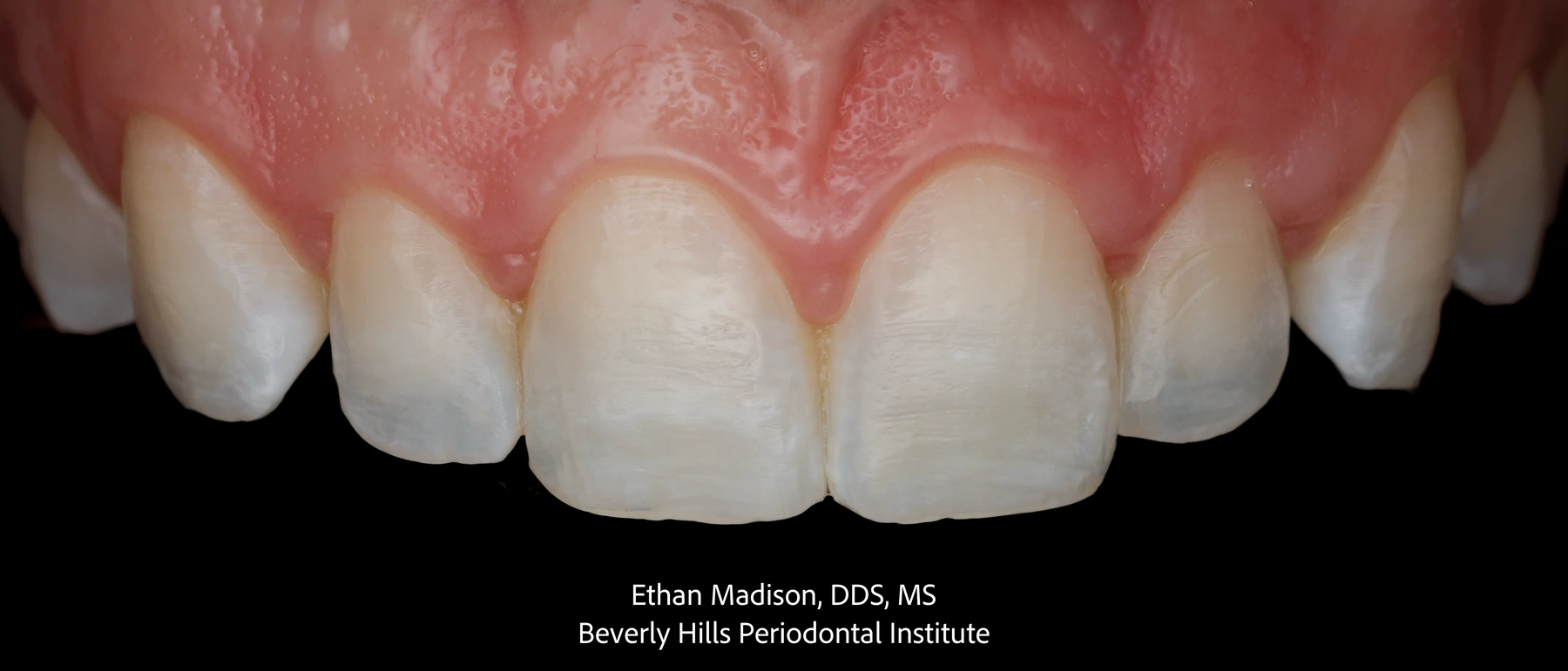 Upper front teeth and gumline of the same patient after esthetic crown lengthening