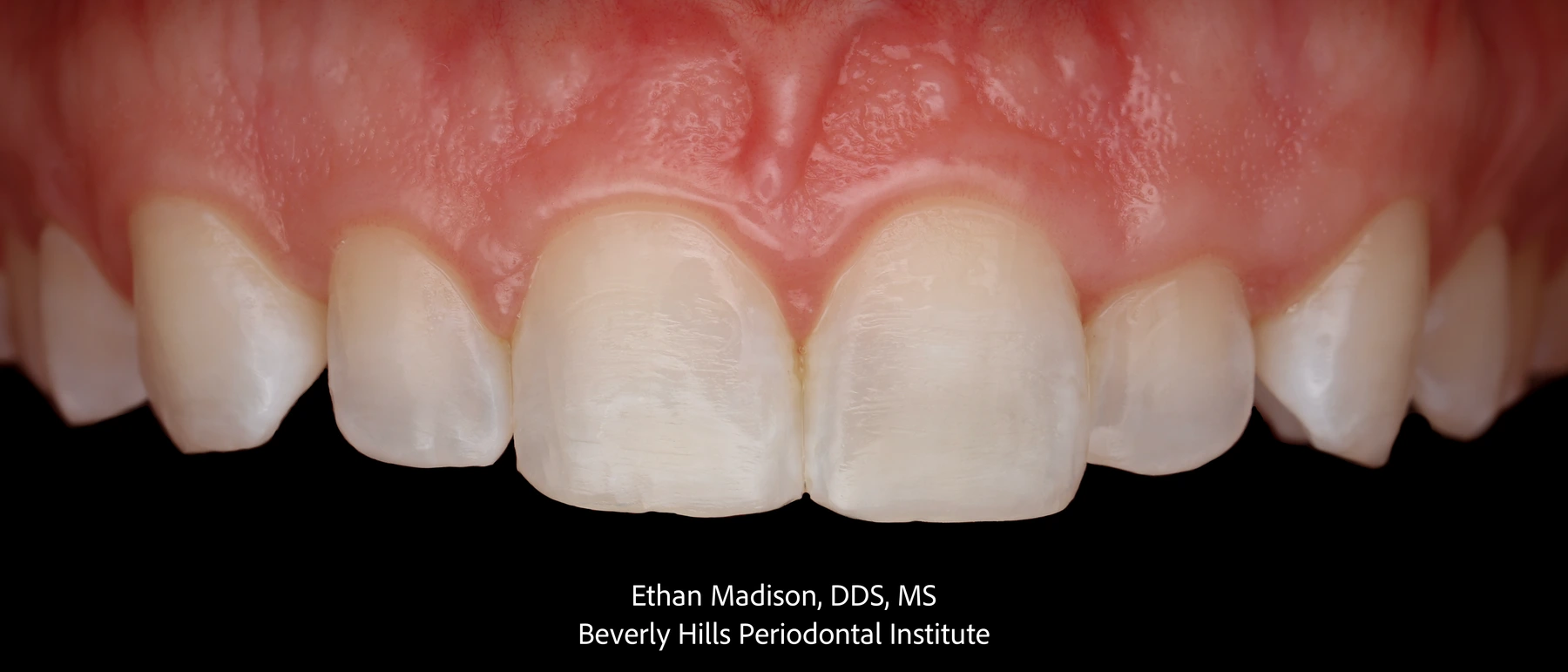 Upper front teeth and gumline before esthetic crown lengthening