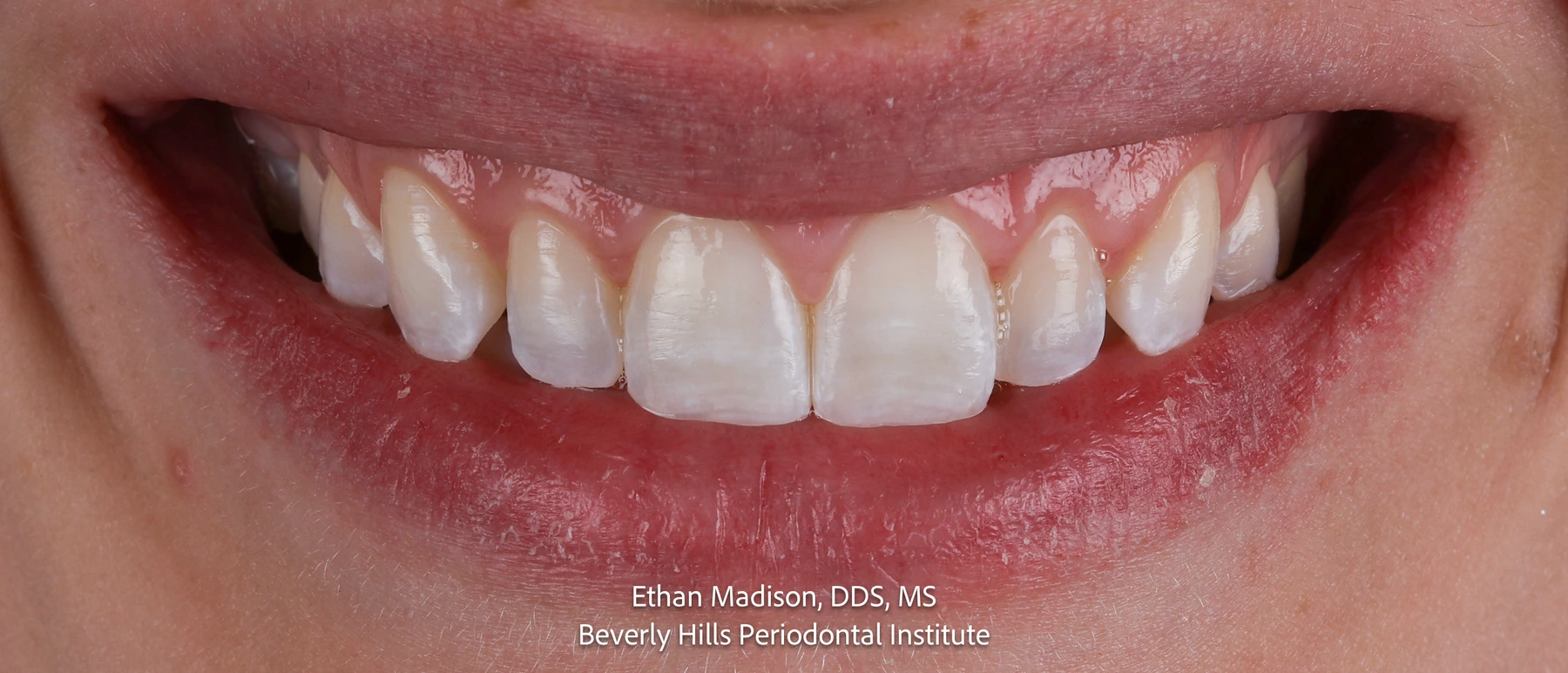 The same patient smiling after esthetic crown lengthening
