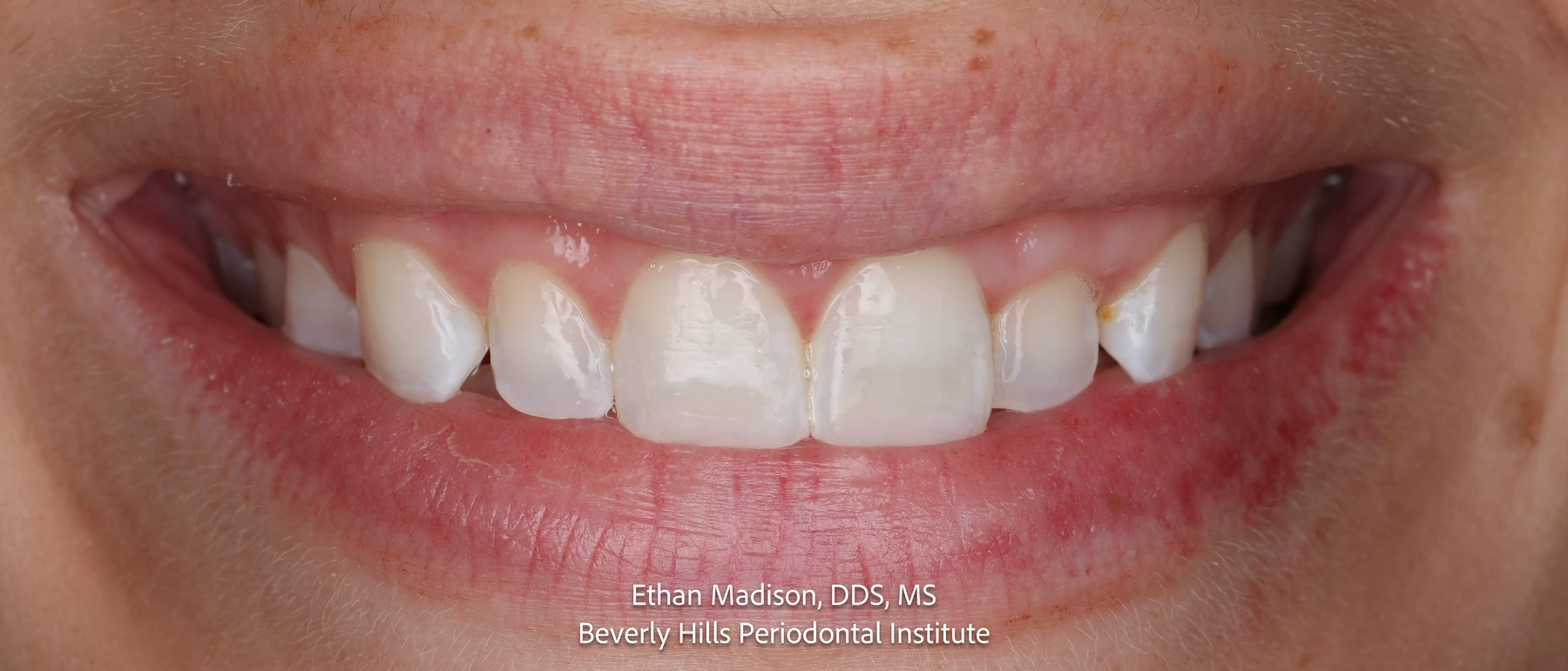 Patient smiling before esthetic crown lengthening