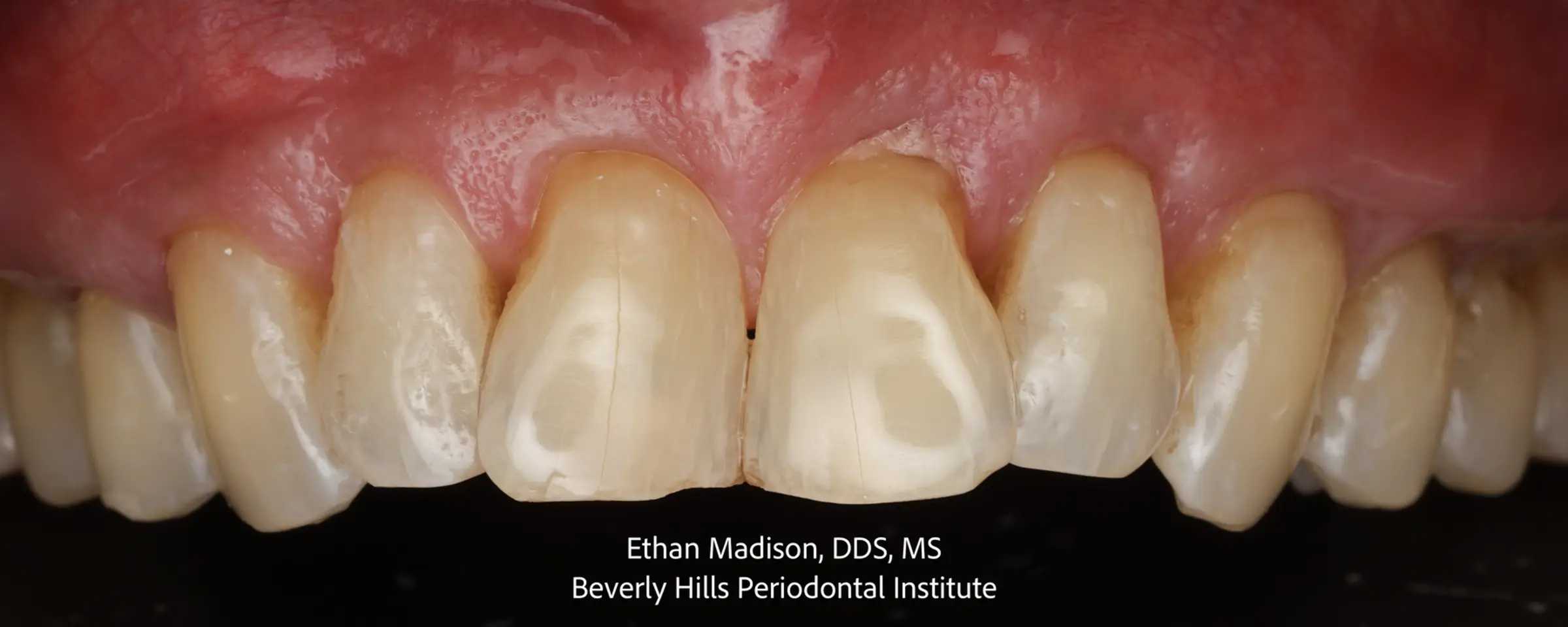 The same upper arch after grafting, with the gum margins restored over the previously exposed roots