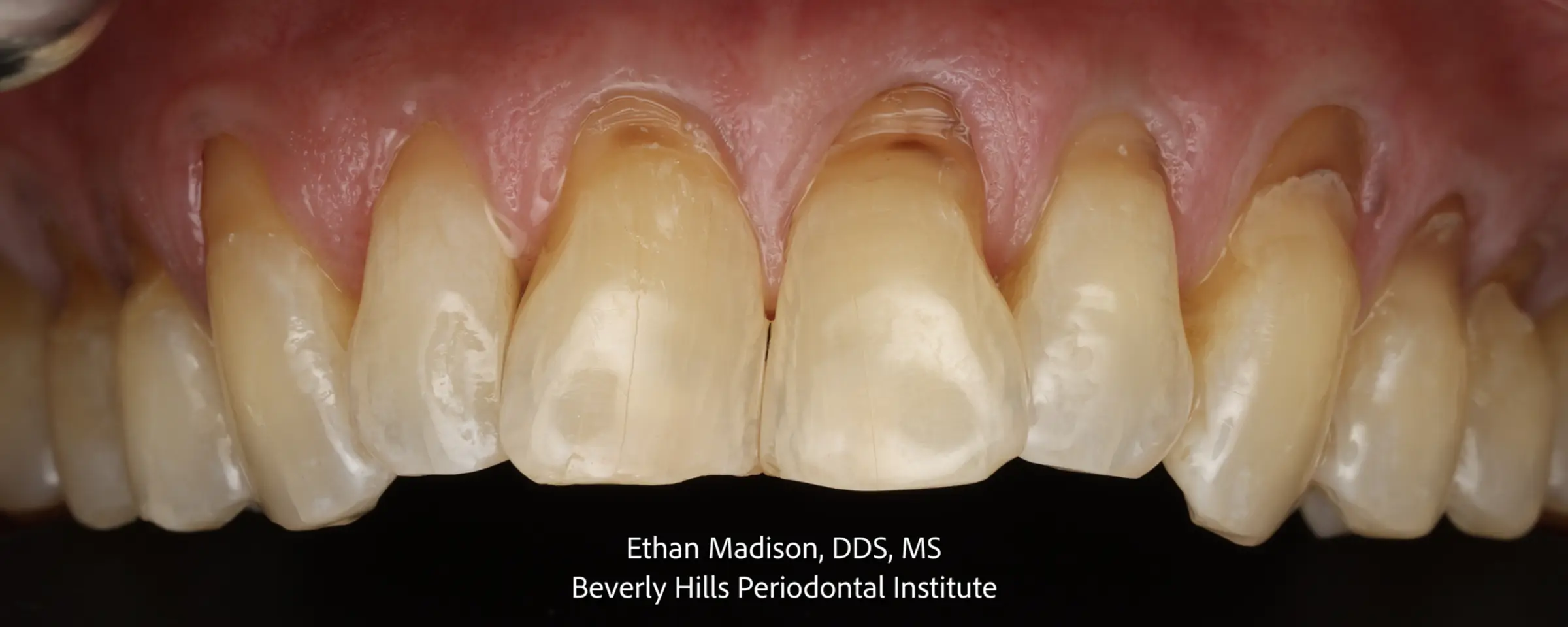 Generalized gum recession across the upper arch, with exposed root surfaces and worn notches at the gum line on the canines and premolars