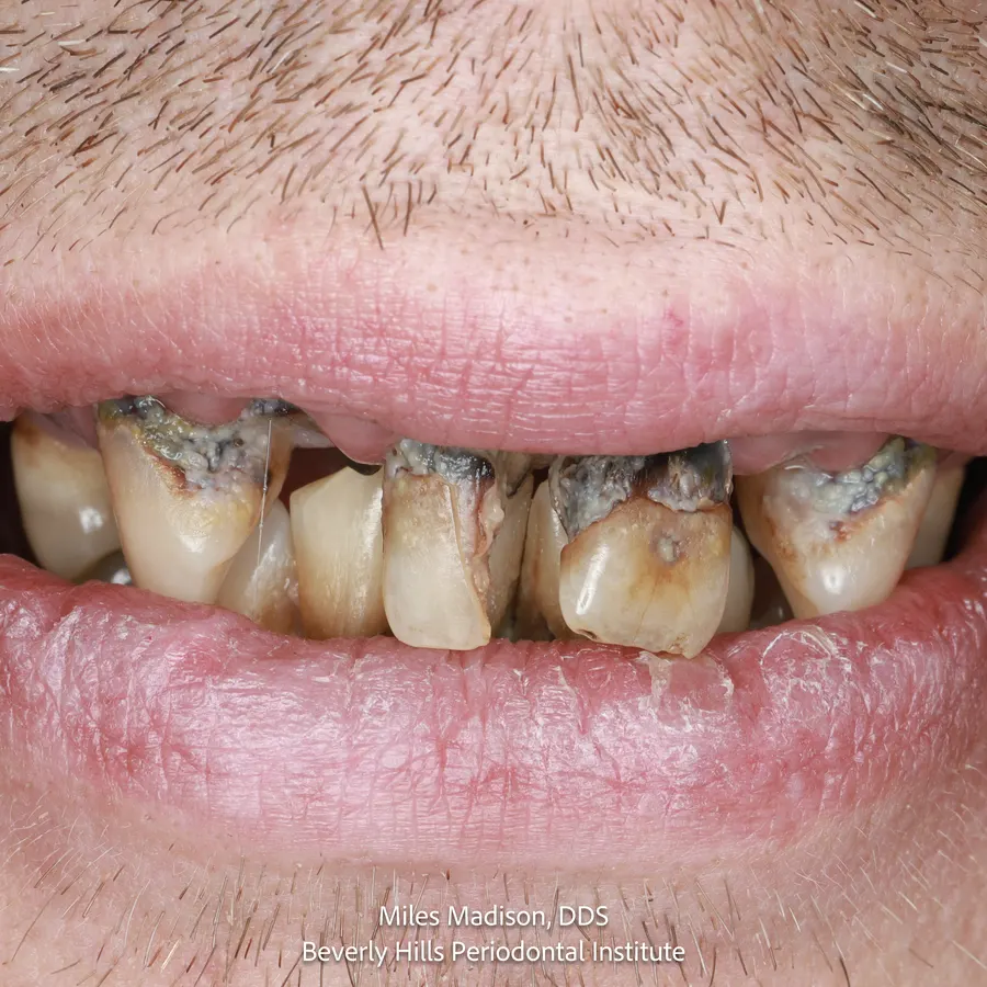 Terminal upper dentition before full-arch implant reconstruction: worn, darkened upper teeth with extensive decay at the gum line